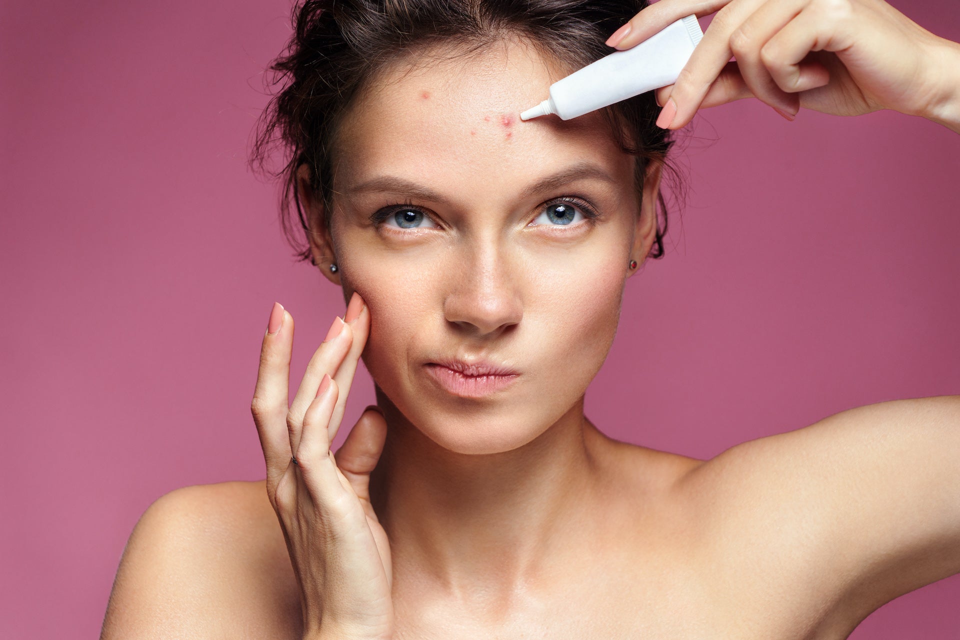 Acne 101 - What is acne?