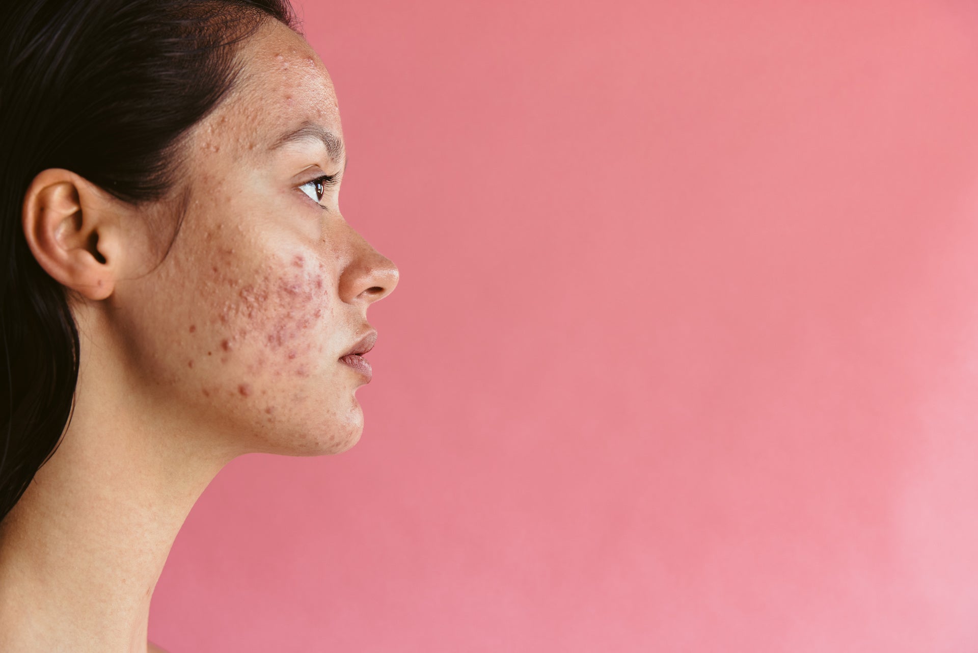 Acne 101 - What kind of acne do I have?